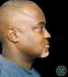 Neck Lift case #4890