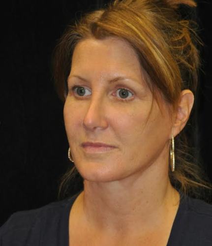 Lower Blepharoplasty case #3417