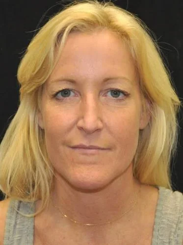 Blepharoplasty case #3514