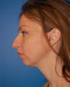 Profile Balancing case #12698