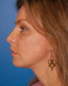 Profile Balancing case #12698
