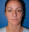 Rhinoplasty case #12747