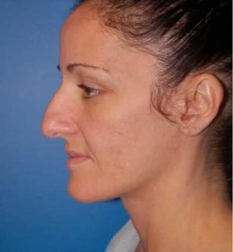 Rhinoplasty case #12747