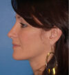 Rhinoplasty case #12747