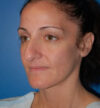 Rhinoplasty case #12747