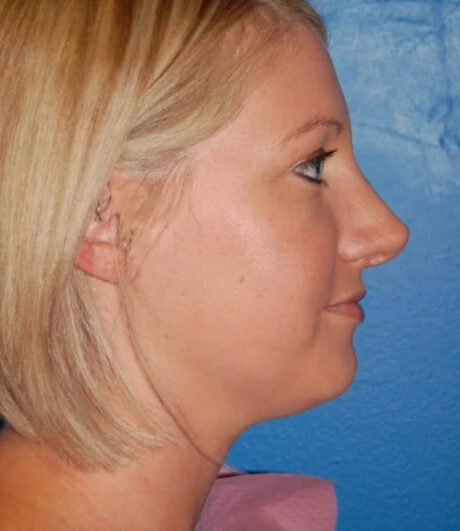 Revision Rhinoplasty case #13397