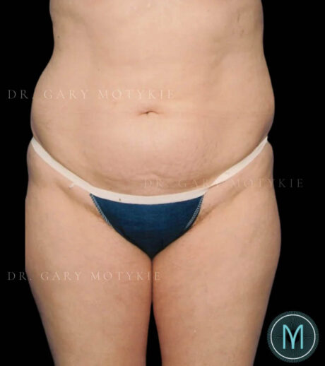 Tummy Tuck case #13505