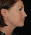Revision Rhinoplasty case #13397