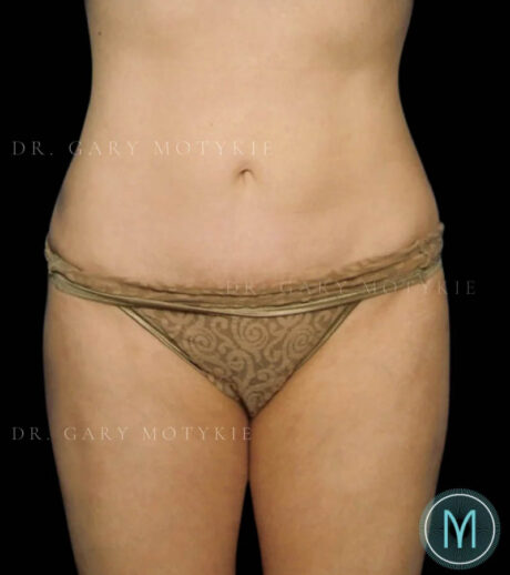 Tummy Tuck case #13505