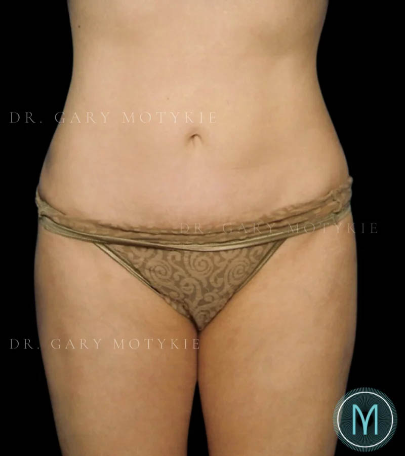 Tummy Tuck case #13505