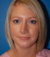 Revision Rhinoplasty case #13397