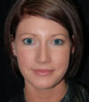 Revision Rhinoplasty case #13397