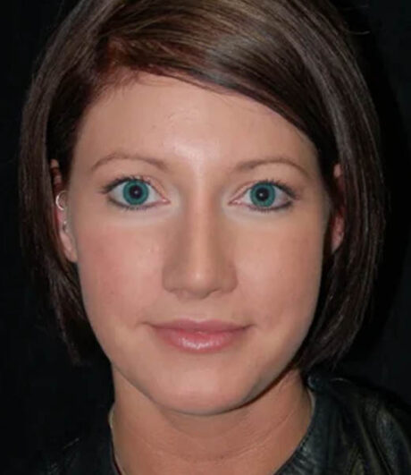 Revision Rhinoplasty case #13397