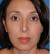Rhinoplasty case #12754
