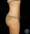Tummy Tuck case #13505