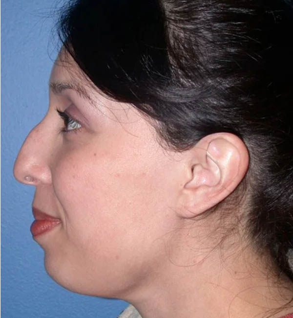 Rhinoplasty case #12754