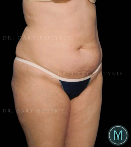 Tummy Tuck case #13505