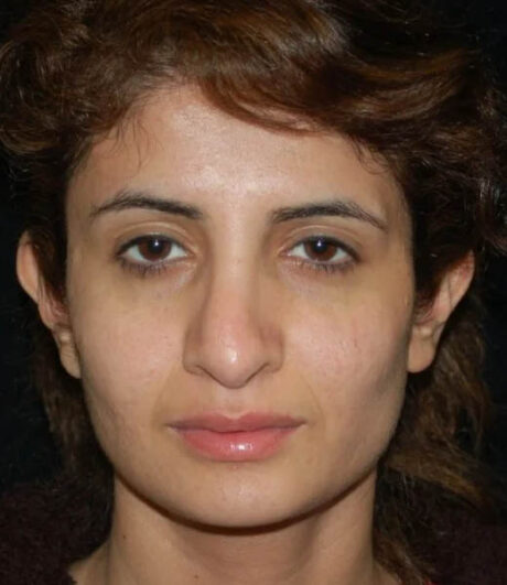 Revision Rhinoplasty case #13402