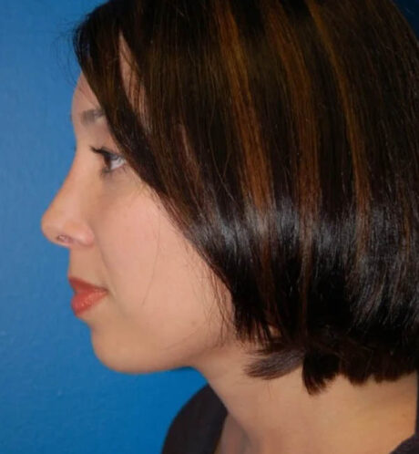 Rhinoplasty case #12754