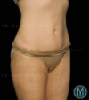 Tummy Tuck case #13505