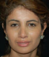 Revision Rhinoplasty case #13402