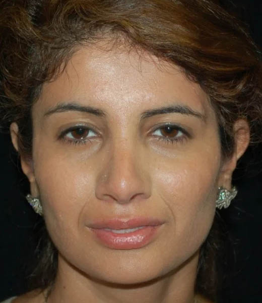 Revision Rhinoplasty case #13402