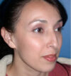 Rhinoplasty case #12754