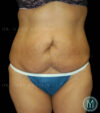 Tummy Tuck case #13512