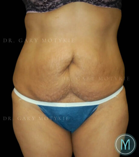 Tummy Tuck case #13512