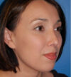 Rhinoplasty case #12754