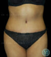 Tummy Tuck case #13512