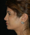 Revision Rhinoplasty case #13402