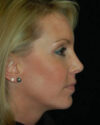Profile Balancing case #12714