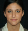 Rhinoplasty case #12761