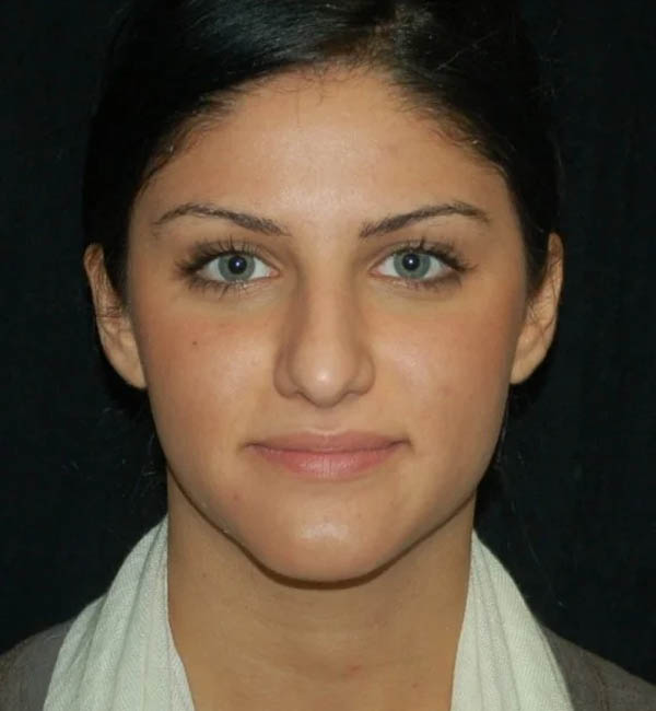 Rhinoplasty case #12761