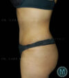 Tummy Tuck case #13512