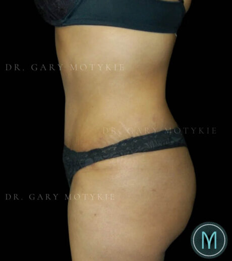 Tummy Tuck case #13512