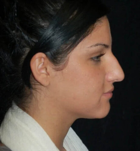 Rhinoplasty case #12761