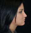 Rhinoplasty case #12761