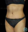 Tummy Tuck case #13512
