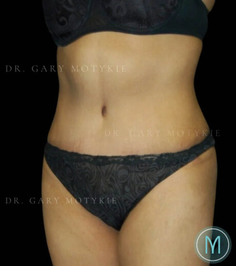 Tummy Tuck case #13512