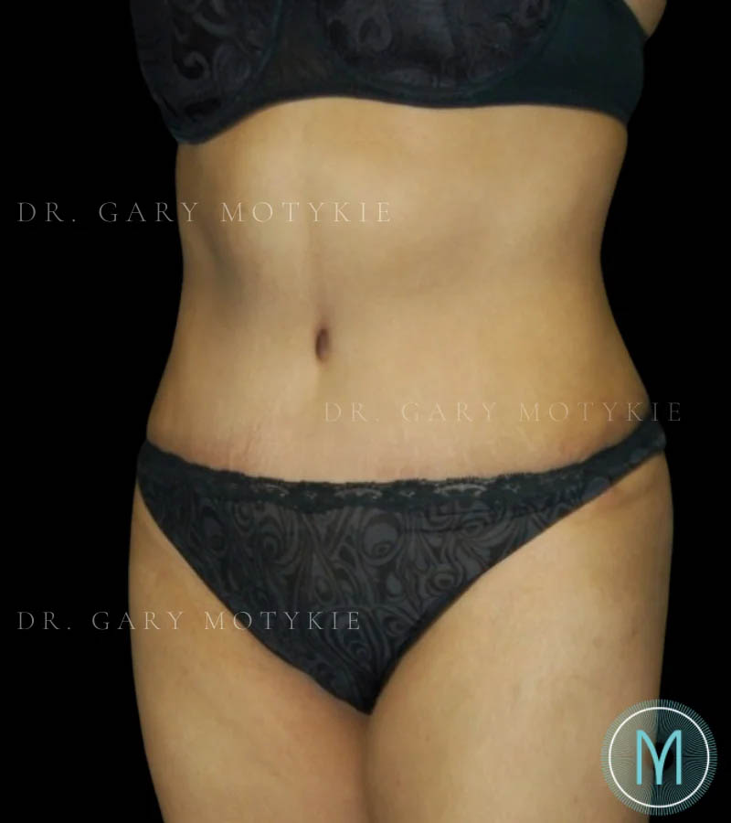 Tummy Tuck case #13512