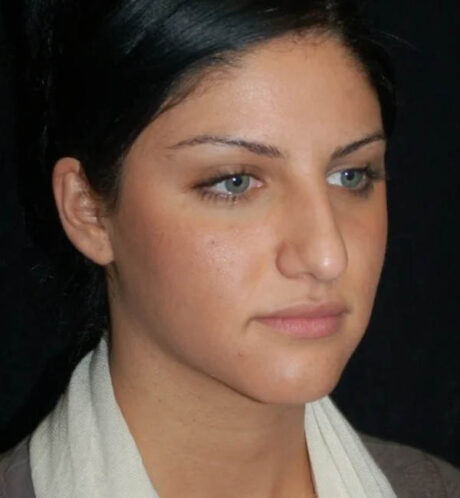 Rhinoplasty case #12761