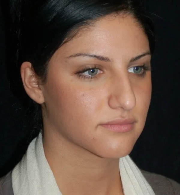 Rhinoplasty case #12761