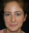 Revision Rhinoplasty case #13409