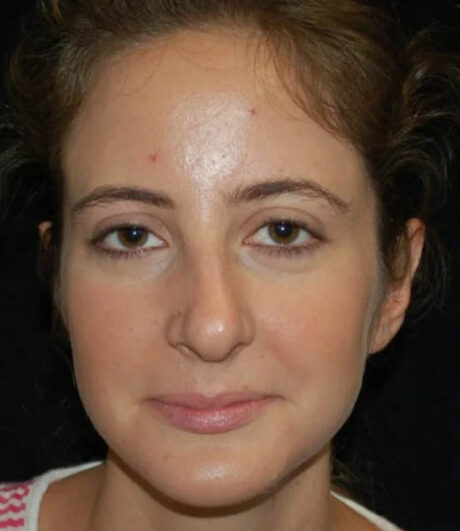 Revision Rhinoplasty case #13409