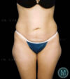 Tummy Tuck case #13519