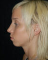 Profile Balancing case #12722