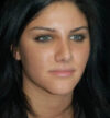 Rhinoplasty case #12761