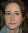 Revision Rhinoplasty case #13409